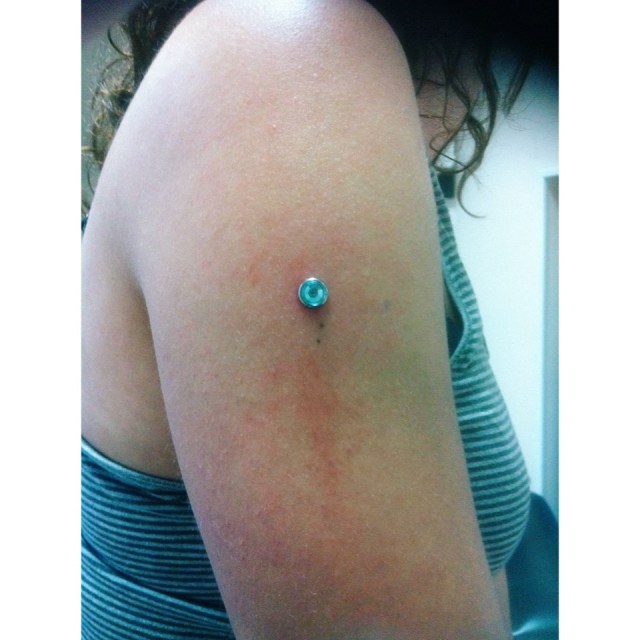 Dermal Anchor Arm