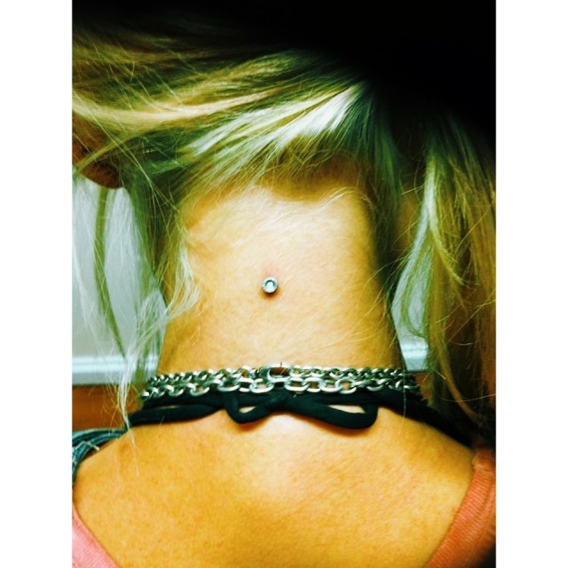 Nape Dermal a year on...