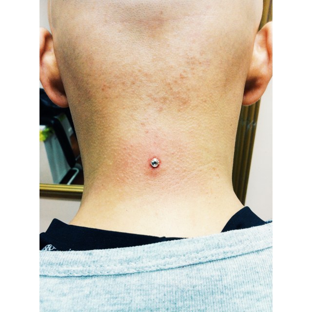 Nape Dermal