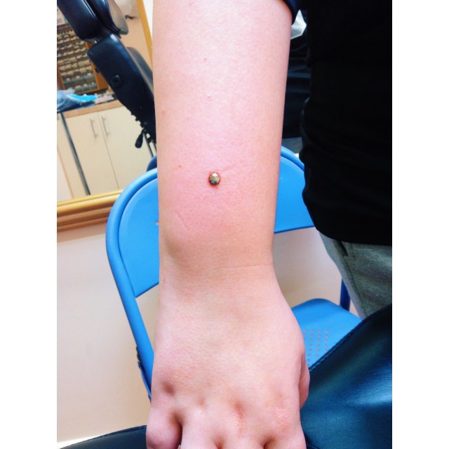 Chantelle's Forearm Dermal Piercing II