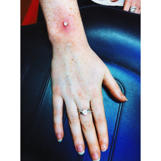 Chloe's Wrist Dermal Anchor