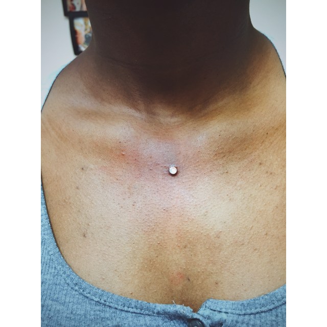 Hannah's Sternum Dermal Anchor