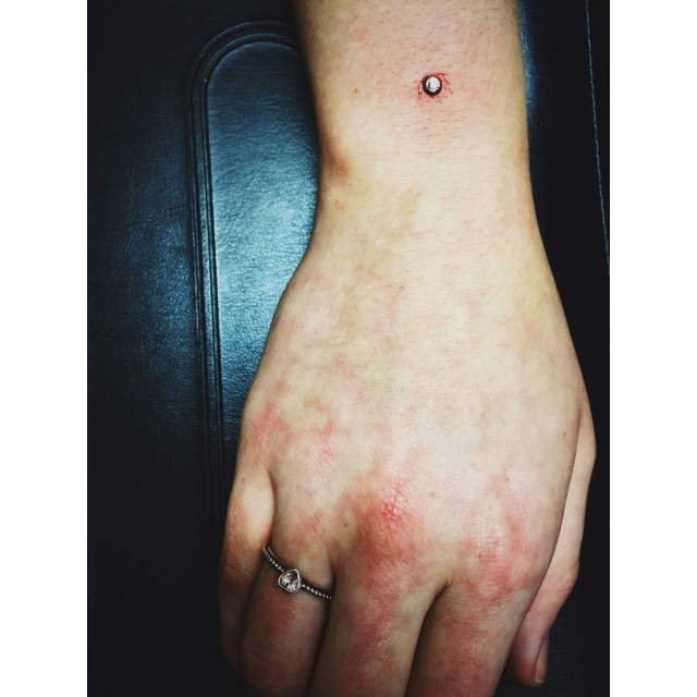 Wrist Dermal I