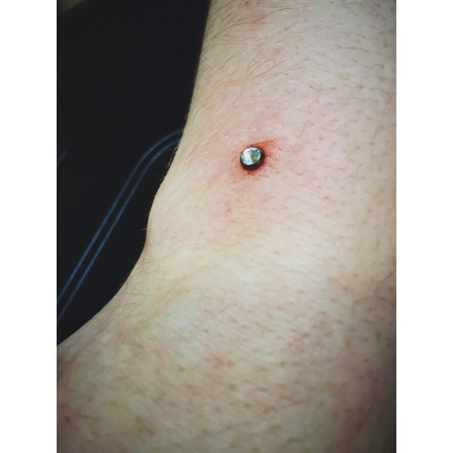 Wrist Dermal II